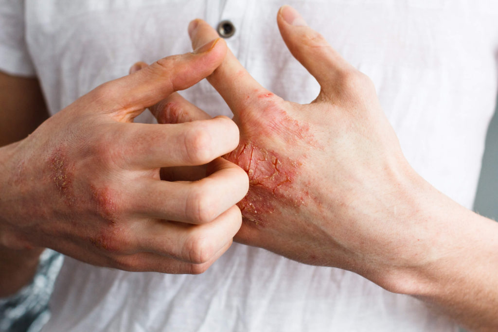 hand with eczema