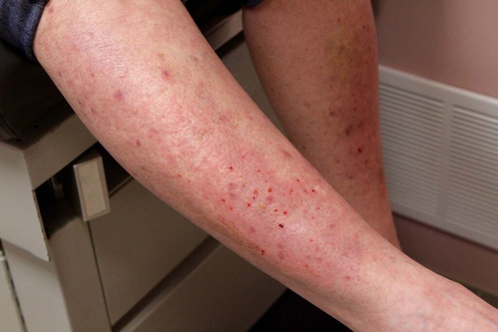 dermatitis herpetiformis